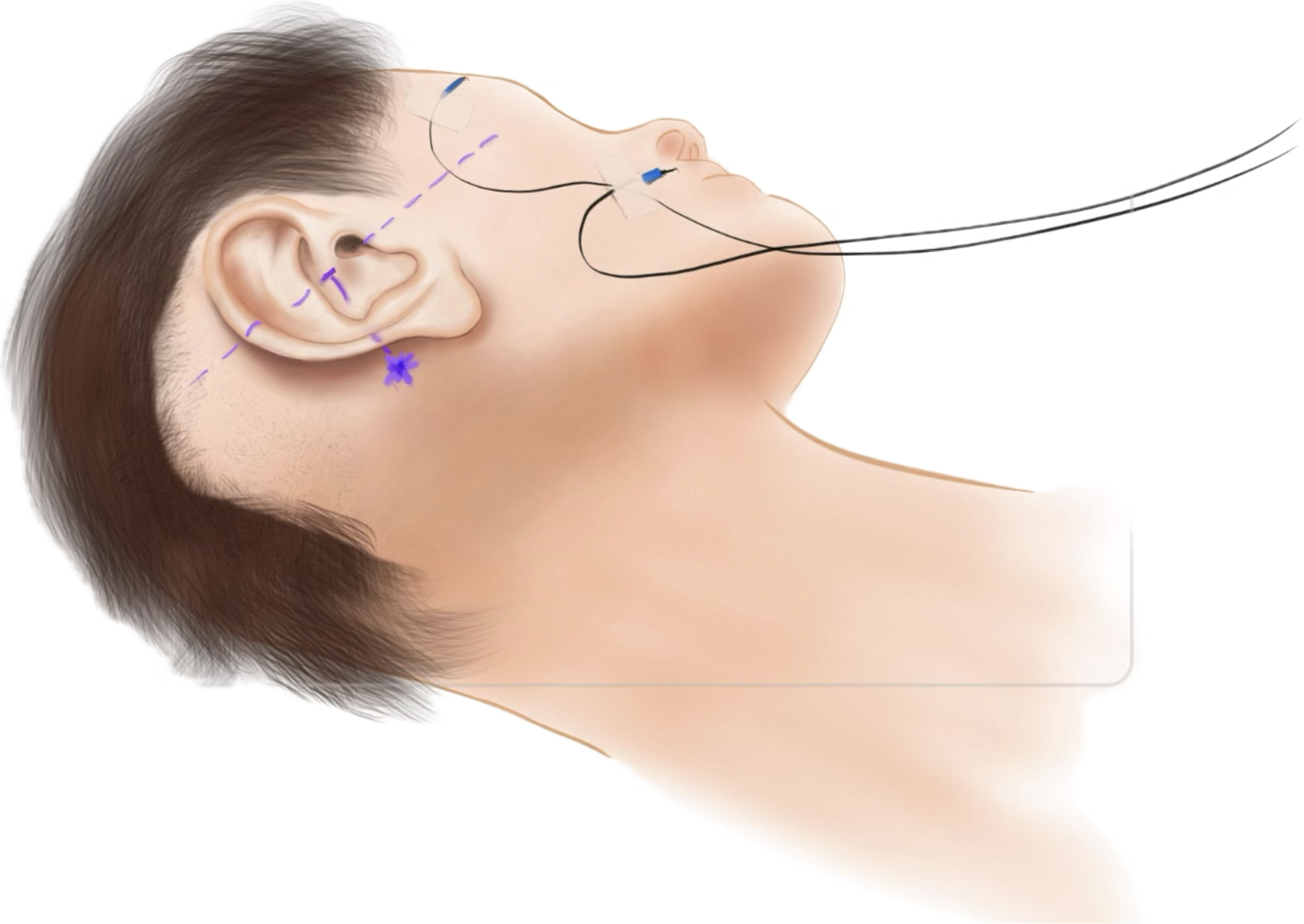 FacialNerveMonitoring