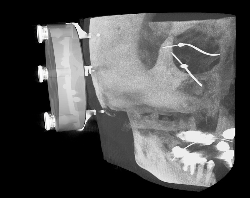 CT scan showing our Mini-stereotactic frame and X-Ray Marker with Jig Fastener attached to a skull.