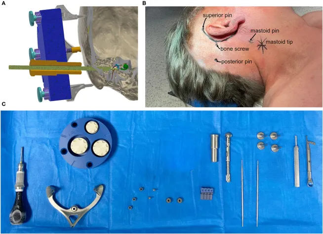 Figure showing mini-stereotactic frame from the first-in-human clinical trial publication